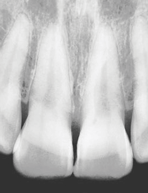 raio-x dentes