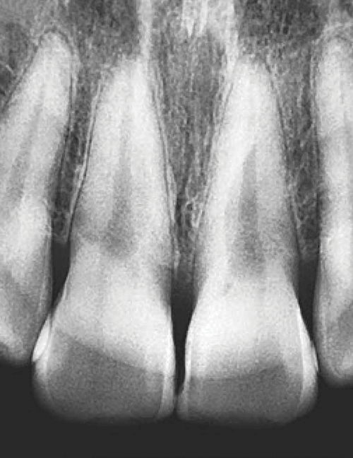 raio-x dentes